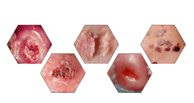 Proč jsou papilomy nebezpečné