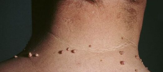 jak se zbavit papilomů