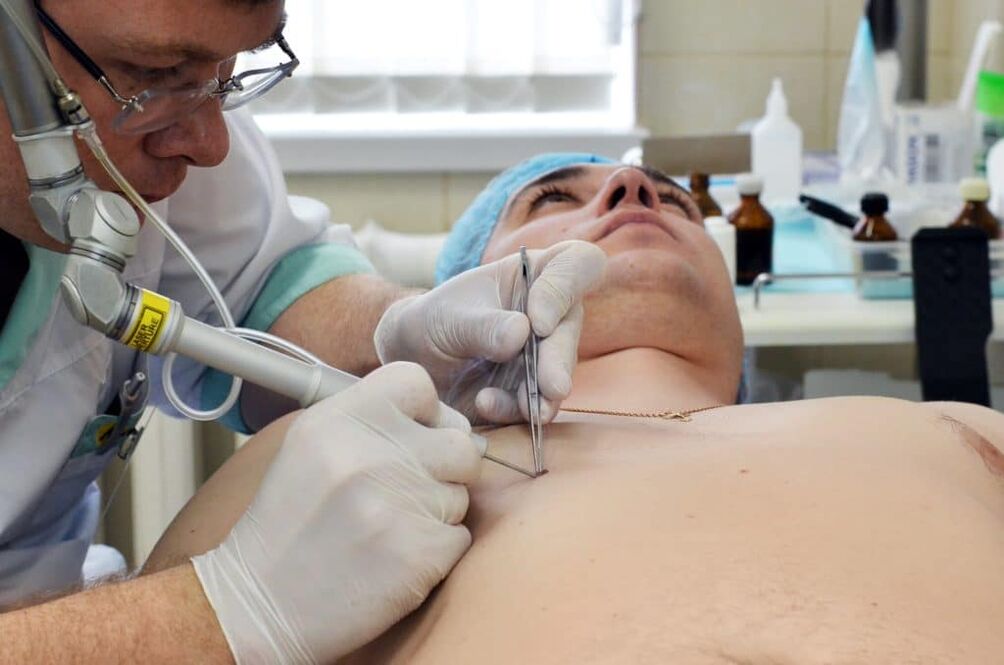 jak se zbavit bradavic na těle