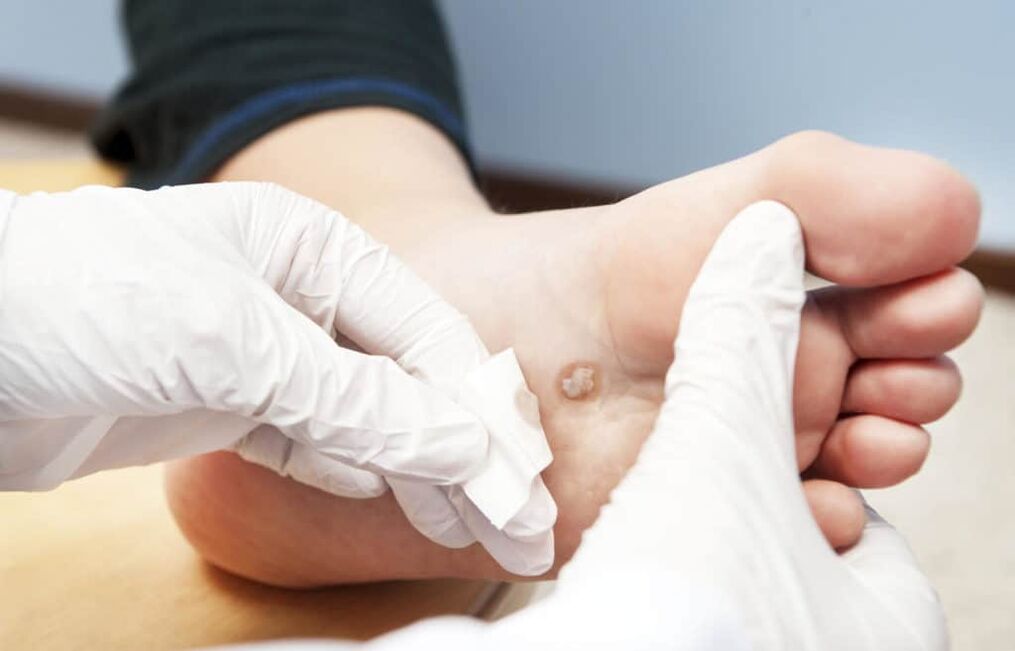 proč se na těle objevují bradavice