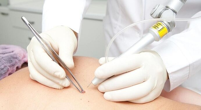 laserové odstranění papilomu pro papilomavirus