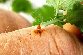 odstranění papilomu šťávou z bylin z bylinek