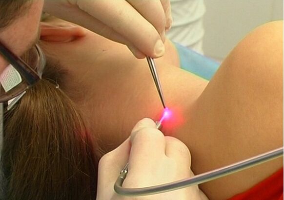 Nízkotraumatická metoda laserového odstranění papilomů